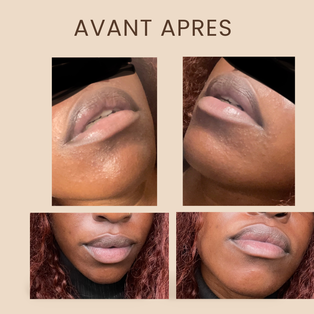 SAVON NOIR NIGERIAN PUR (ANTI ACNE)