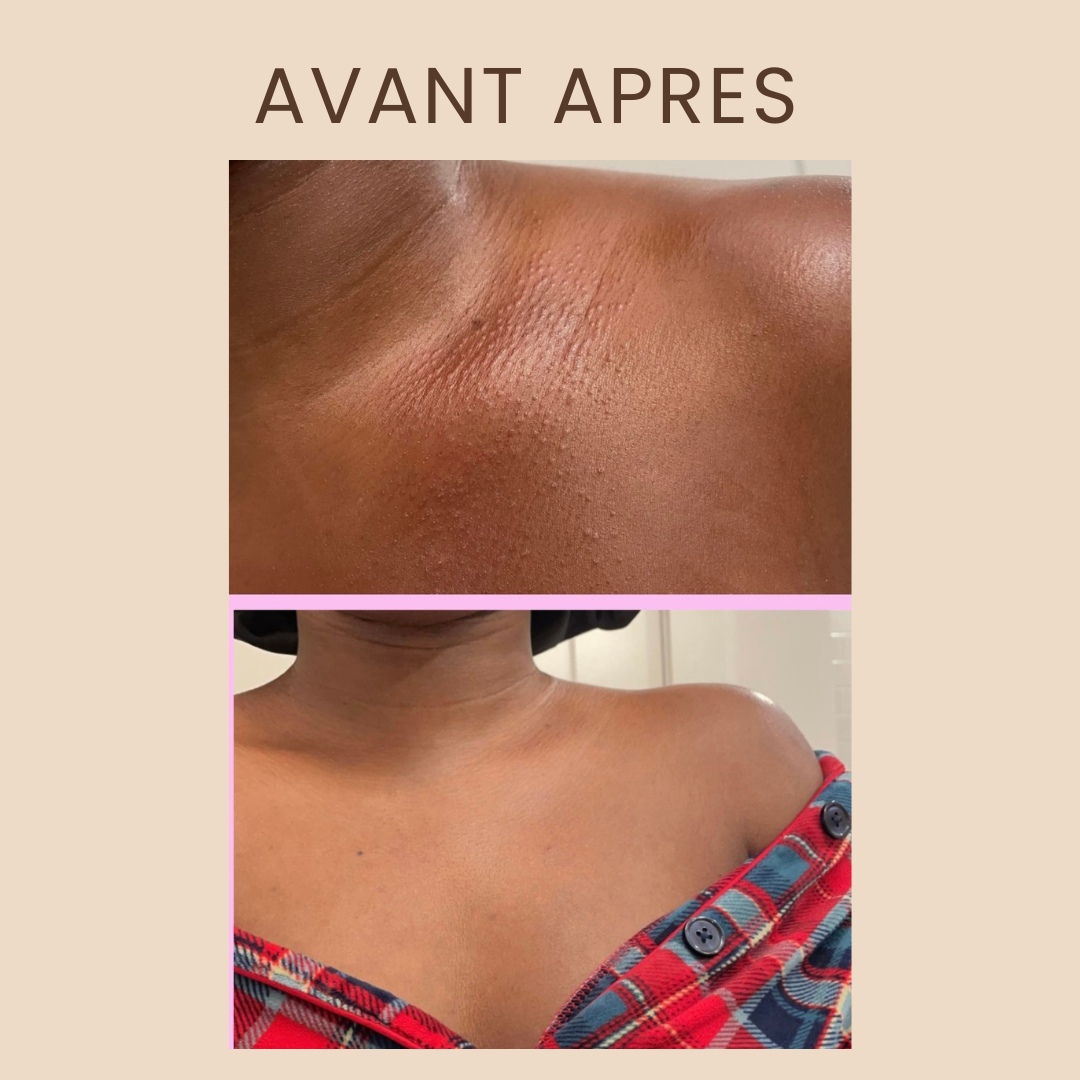 SAVON NOIR NIGERIAN PUR (ANTI ACNE)